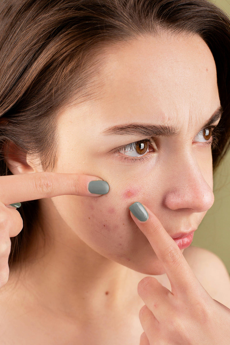 Atasi Jerawat Dengan Pengaplikasian Moisturizer